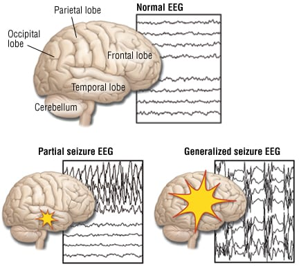 AI Beats Humans in EEG Interpretation Accuracy