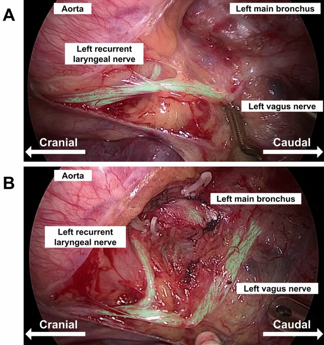 AI-Powered Surgical Support – Enhancing Thoracic Nerve Recognition