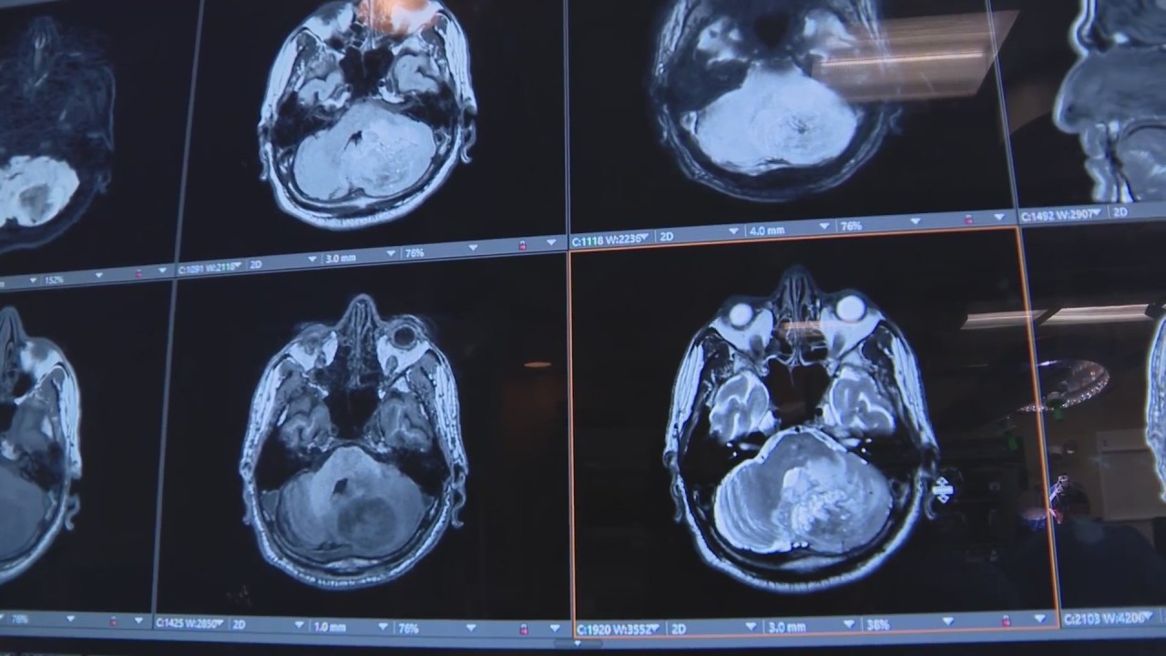 AI Revolutionizes Brain Surgery with Real-Time Tumor Analysis