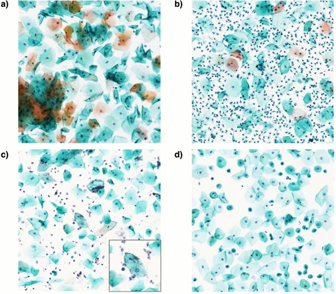 Revolutionizing Cervical Cytology – AI’s Role in Screening Efficiency