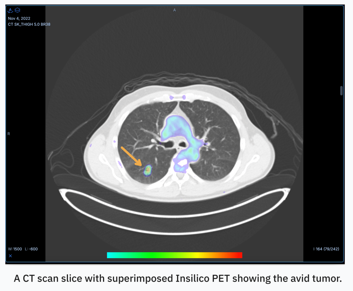 Revolutionizing Cancer Detection – AI-Powered PET Scans
